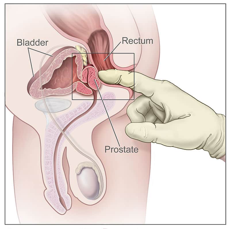 Grafik: Rektum, in das ein Finger eingeführt wird und die Prostata ertastet